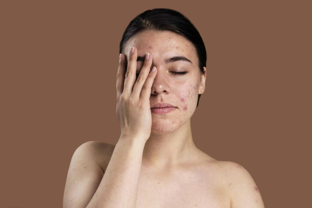 portrait-young-woman-being-confident-with-her-acne
